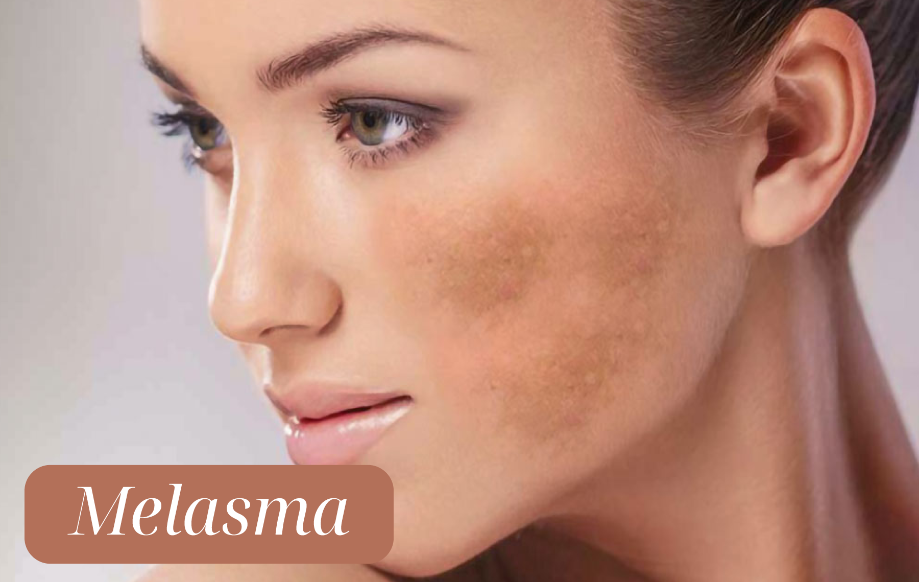 melasma-2